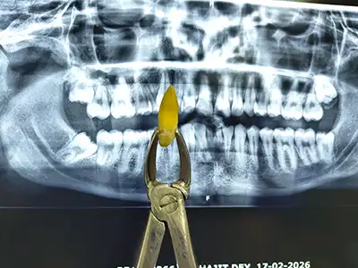 PAINLESS TOOTH EXTRACTION AT DENTITY DENTAL IN KOLKATA