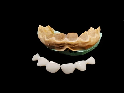 PORCELAIN VENEERS FOR SMILE MAKEOVER AT DENTITY DENTAL IN KOLKATA